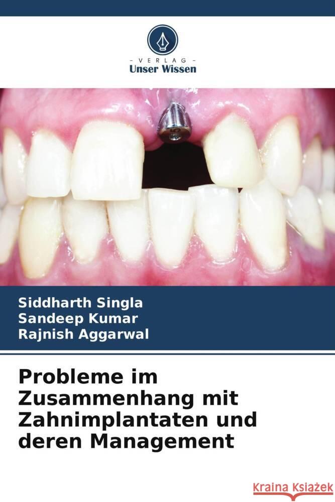 Probleme im Zusammenhang mit Zahnimplantaten und deren Management Singla, Siddharth, Kumar, Sandeep, AGGARWAL, RAJNISH 9786205108925 Verlag Unser Wissen - książka