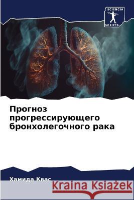 Prognoz progressiruüschego bronholegochnogo raka Kwas, Hamida 9786205964194 Sciencia Scripts - książka