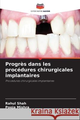 Progr?s dans les proc?dures chirurgicales implantaires Rahul Shah Pooja Mishra 9786207635269 Editions Notre Savoir - książka