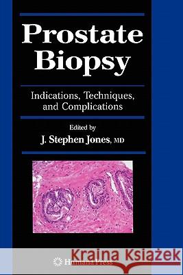 Prostate Biopsy: Indications, Techniques, and Complications Jones, J. Stephen 9781617377808 Springer - książka