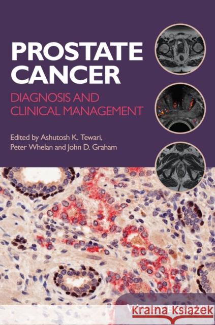 Prostate Cancer: Diagnosis and Clinical Management Tewari, Ashutosh K. 9781118347355 John Wiley & Sons - książka