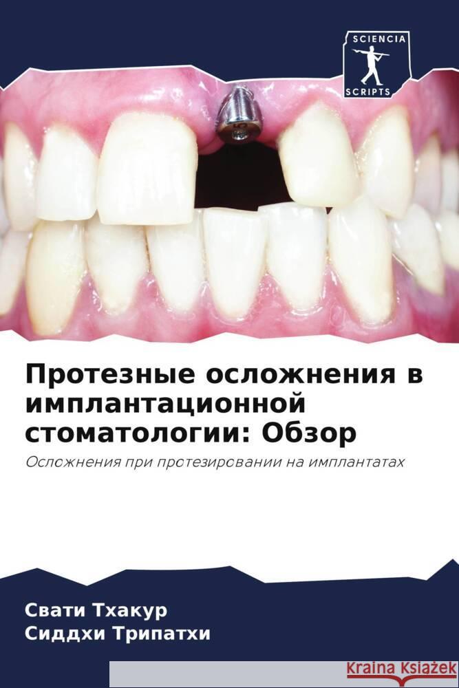 Proteznye oslozhneniq w implantacionnoj stomatologii: Obzor Thakur, Swati, Tripathi, Siddhi 9786205452837 Sciencia Scripts - książka