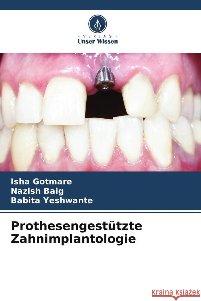 Prothesengest?tzte Zahnimplantologie Isha Gotmare Nazish Baig Babita Yeshwante 9786207077793 Verlag Unser Wissen - książka