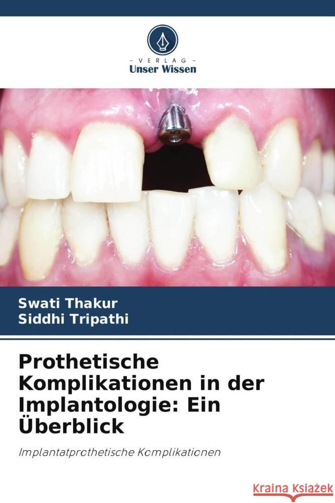 Prothetische Komplikationen in der Implantologie: Ein Überblick Thakur, Swati, Tripathi, Siddhi 9786205452677 Verlag Unser Wissen - książka