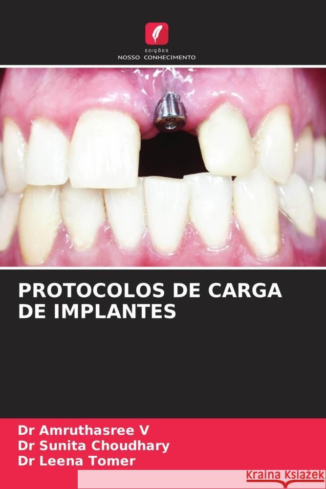 Protocolos de Carga de Implantes Dr Amruthasree V Dr Sunita Choudhary Dr Leena Tomer 9786206247838 Edicoes Nosso Conhecimento - książka