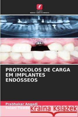 Protocolos de Carga Em Implantes Endosseos Prabhakar Angadi Saloni Tawde  9786205934852 Edicoes Nosso Conhecimento - książka