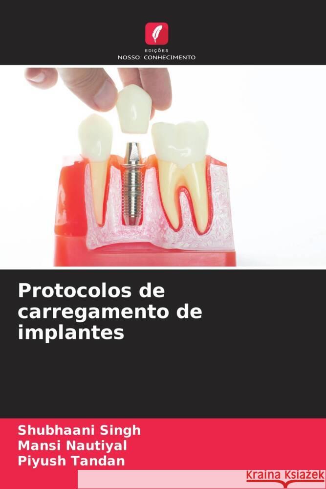 Protocolos de carregamento de implantes Singh, Shubhaani, Nautiyal, Mansi, Tandan, Piyush 9786204857510 Edições Nosso Conhecimento - książka