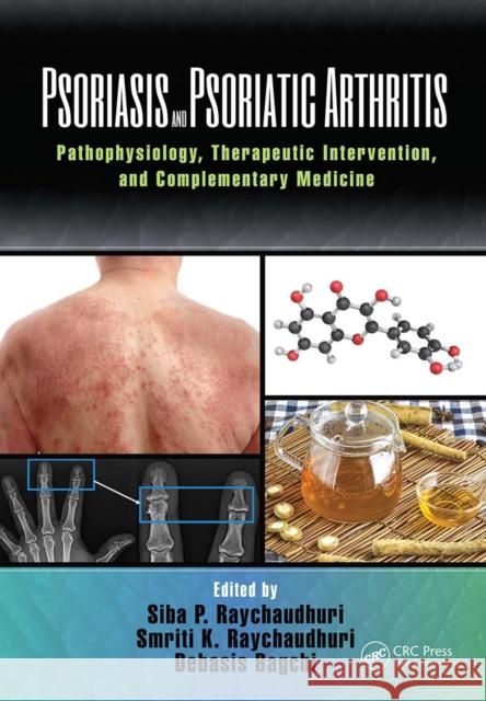 Psoriasis and Psoriatic Arthritis: Pathophysiology, Therapeutic Intervention, and Complementary Medicine Siba P. Raychaudhuri Smriti Raychaudhuri Debasis Bagchi 9781032095868 CRC Press - książka