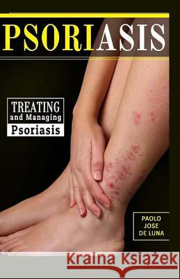 Psoriasis: Treating and Managing Psoriasis Paolo Jos 9781523660049 Createspace Independent Publishing Platform - książka