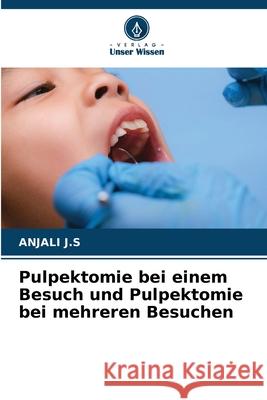 Pulpektomie bei einem Besuch und Pulpektomie bei mehreren Besuchen J.S, ANJALI 9786209095610 Verlag Unser Wissen - książka
