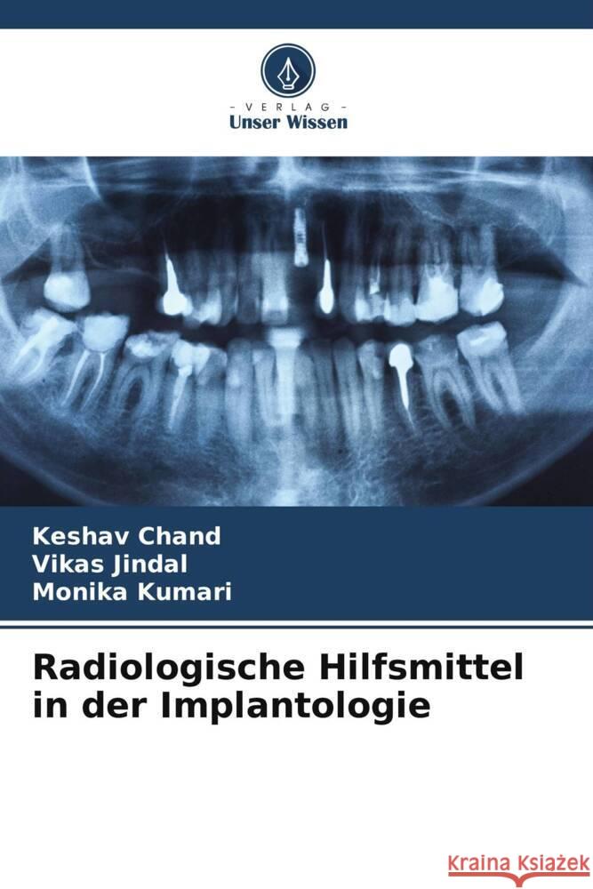 Radiologische Hilfsmittel in der Implantologie Chand, Keshav, Jindal, Vikas, Kumari, Monika 9786208618100 Verlag Unser Wissen - książka