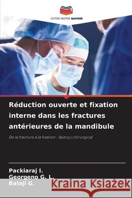 Réduction ouverte et fixation interne dans les fractures antérieures de la mandibule I., Packiaraj, G. L., Georgeno, G., Balaji 9786200819673 Editions Notre Savoir - książka