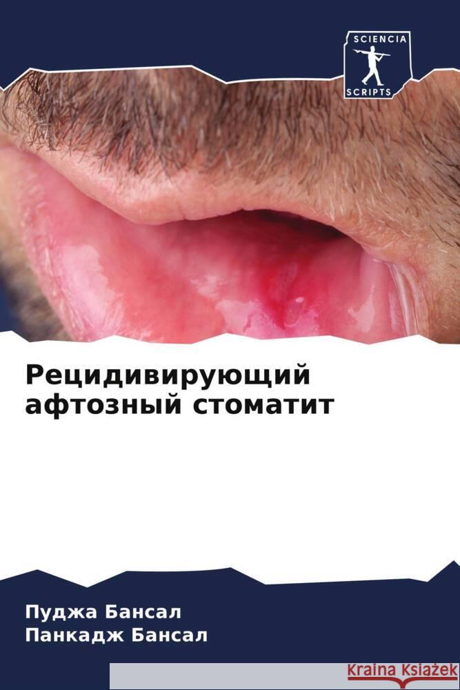 Recidiwiruüschij aftoznyj stomatit Bansal, Pudzha, Bansal, Pankadzh 9786204785608 Sciencia Scripts - książka