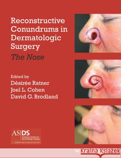 Reconstructive Conundrums in Dermatologic Surgery: The Nose Ratner, Desiree S. 9781118272329 John Wiley & Sons - książka