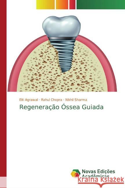 Regeneração Óssea Guiada Agrawal, Eiti; Chopra, Rahul; Sharma, Nikhil 9786200577474 Novas Edicioes Academicas - książka