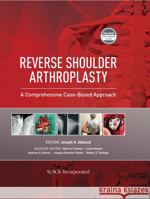 Reverse Shoulder Arthroplasty: A Comprehensive Case-Based Approach J. Abboud 9781630916855 Slack - książka