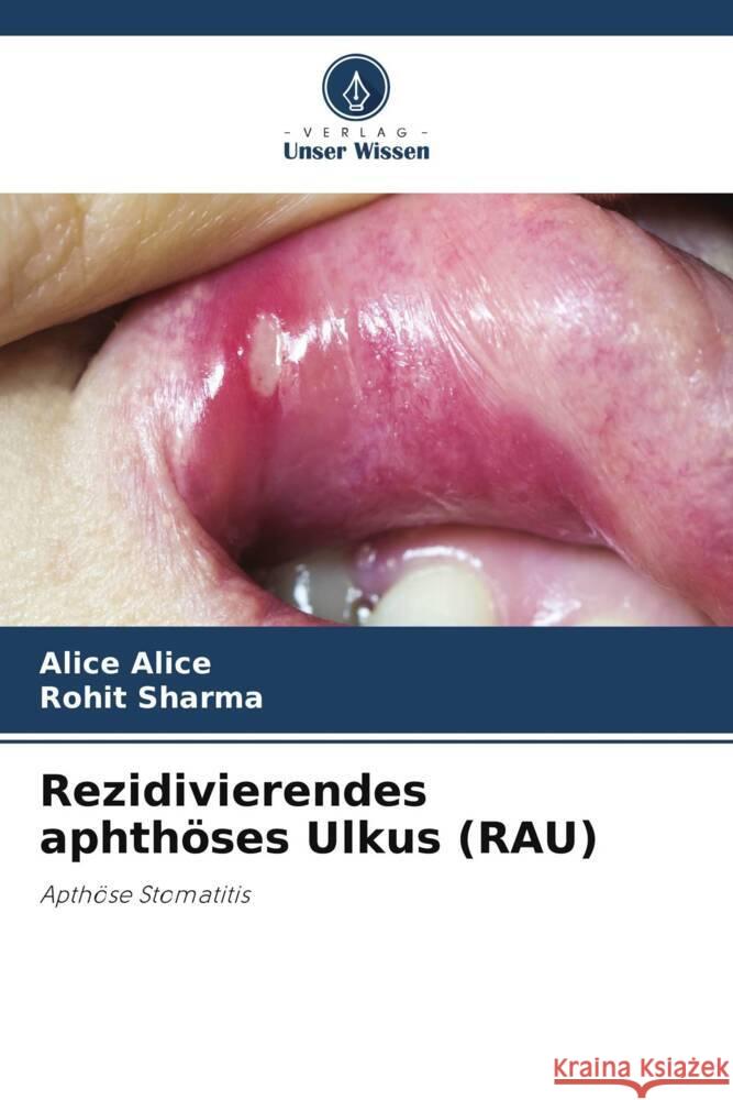 Rezidivierendes aphth?ses Ulkus (RAU) Alice Alice Rohit Sharma 9786207418831 Verlag Unser Wissen - książka