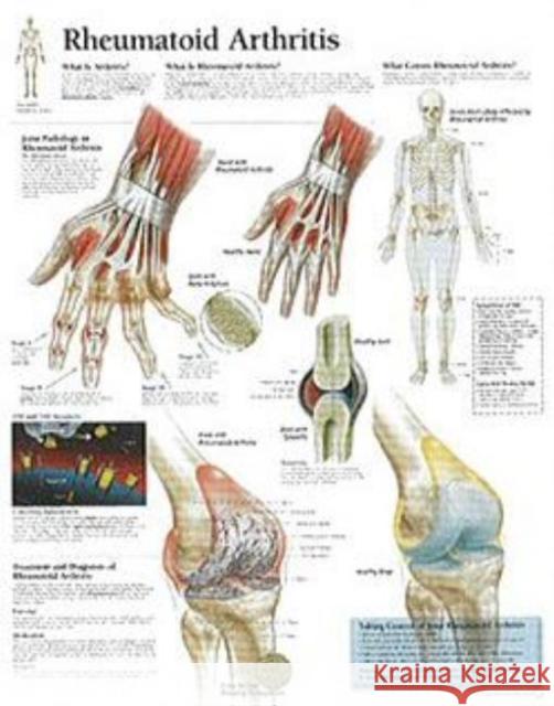 Rheumatoid Arthritis Laminated Poster Scientific Publishing 9781930633391 Scientific Publishing Limited - książka