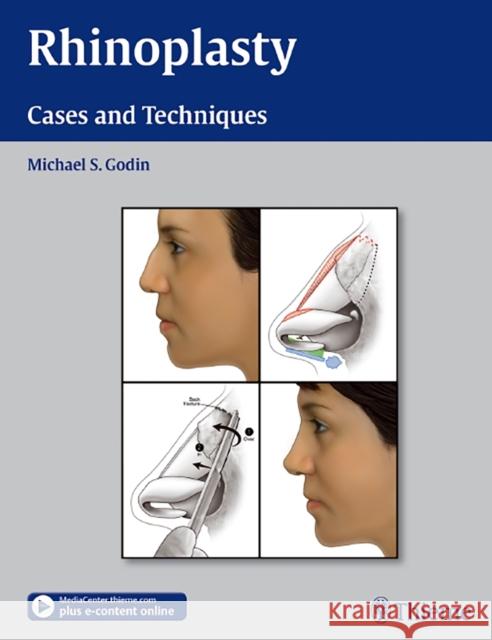 Rhinoplasty - Cases and Techniques: Cases and Techniques Godin, Michael S. 9781604066807 Thieme, New York - książka