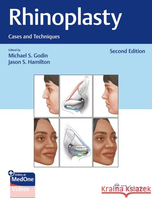 Rhinoplasty: Cases and Techniques Jason S. Hamilton 9781684200603 Thieme Medical Publishers - książka