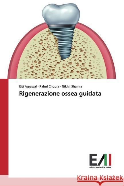 Rigenerazione ossea guidata Agrawal, Eiti; Chopra, Rahul; Sharma, Nikhil 9786200557353 Edizioni Accademiche Italiane - książka