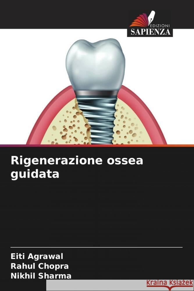 Rigenerazione ossea guidata Agrawal, Eiti, Chopra, Rahul, Sharma, Nikhil 9786204820910 Edizioni Sapienza - książka