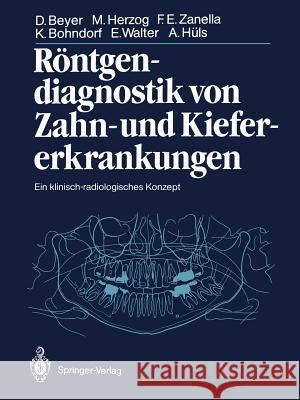 Röntgendiagnostik Von Zahn- Und Kiefererkrankungen: Ein Klinisch-Radiologisches Konzept Beyer, Dieter 9783642710643 Springer - książka