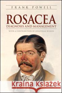 Rosacea: Diagnosis and Management Powell, Frank 9781420072587 Informa Healthcare - książka