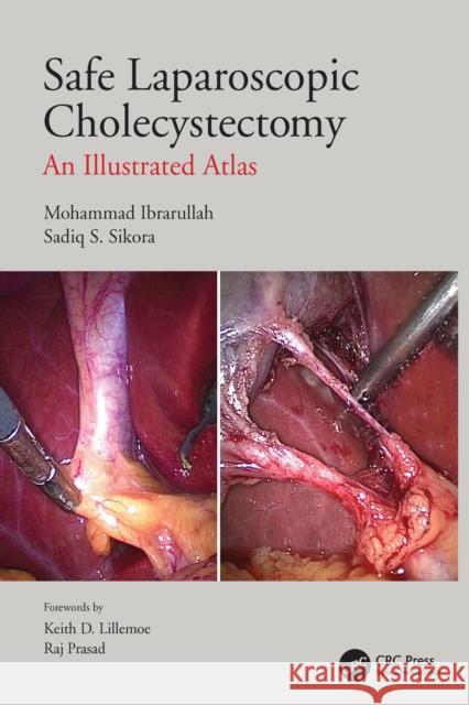 Safe Laparoscopic Cholecystectomy: An Illustrated Atlas Mohammad Ibrarullah Sadiq S. Sikora 9781032005201 CRC Press - książka