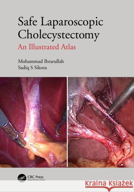 Safe Laparoscopic Cholecystectomy: An Illustrated Atlas Mohammad Ibrarullah Sadiq S. Sikora 9781032005218 CRC Press - książka