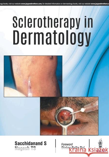 Sclerotherapy In Dermatology Sacchidanand 9789352702060 Jp Medical Ltd - książka