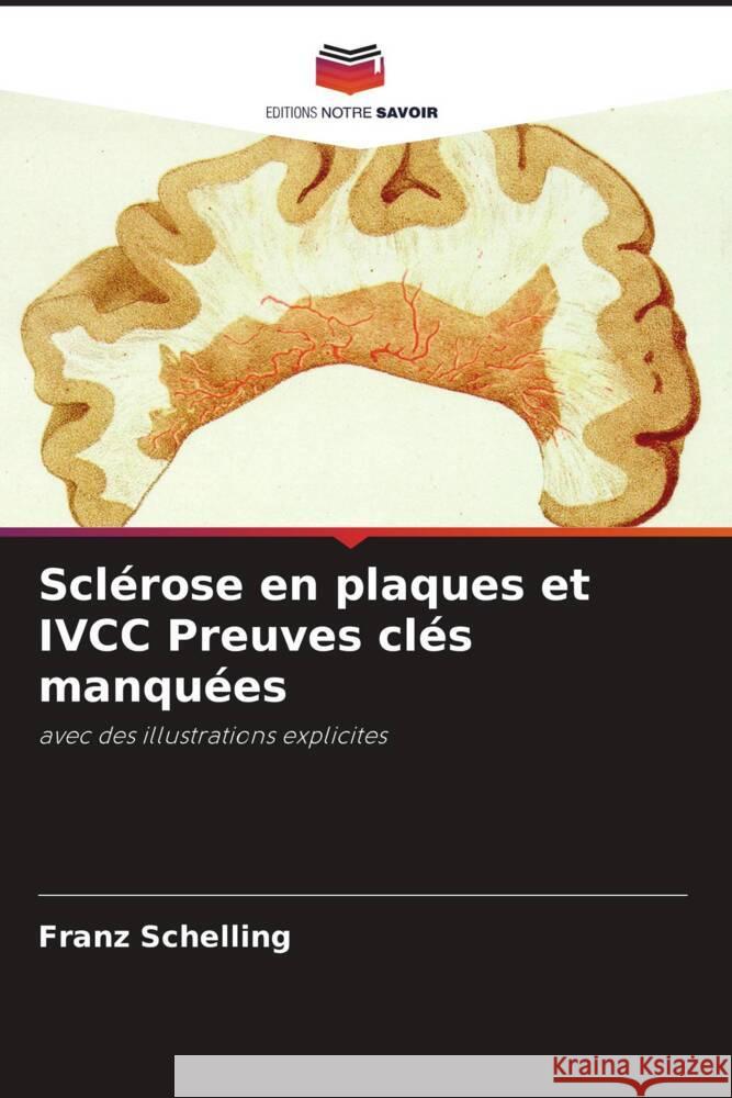 Sclérose en plaques et IVCC Preuves clés manquées Schelling, Franz 9786204376370 Editions Notre Savoir - książka