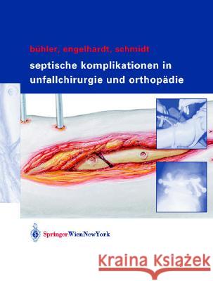 Septische Postoperative Komplikationen: Atlas Für Unfallchirurgen Und Orthopäden Bühler, Matthias 9783211838112 Springer, Wien - książka