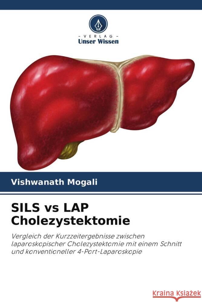 SILS vs LAP Cholezystektomie Mogali, Vishwanath 9786204673721 Verlag Unser Wissen - książka