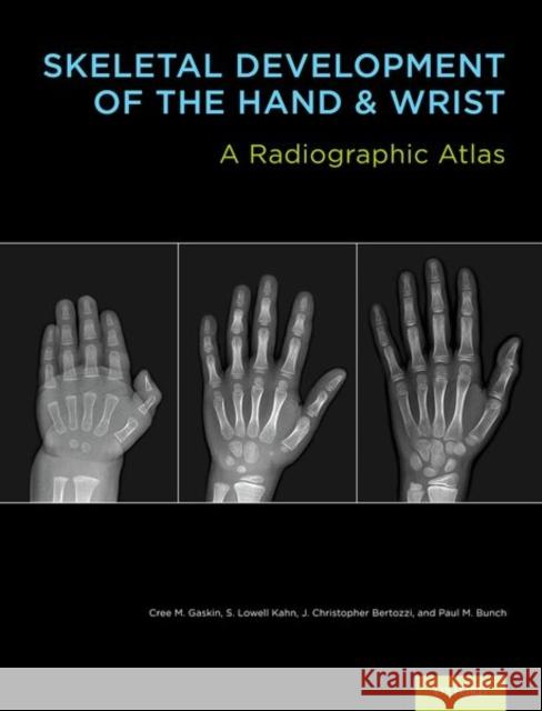 Skeletal Development of the Hand & Wrist: A Radiographic Atlas & Digital Bone Age Companion [With DVD] Gaskin, Cree M. 9780199782055 Oxford University Press, USA - książka