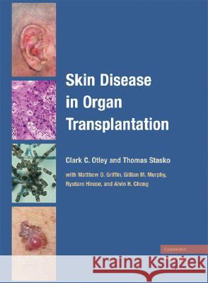 Skin Disease in Organ Transplantation Clark C Otley 9780521870672  - książka