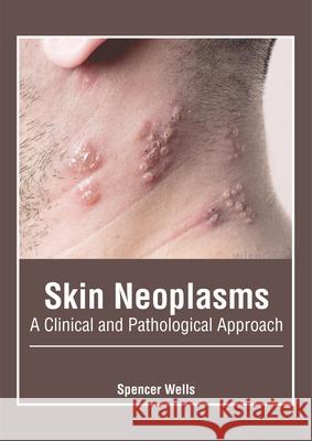 Skin Neoplasms: A Clinical and Pathological Approach Spencer Wells 9781632426215 Foster Academics - książka