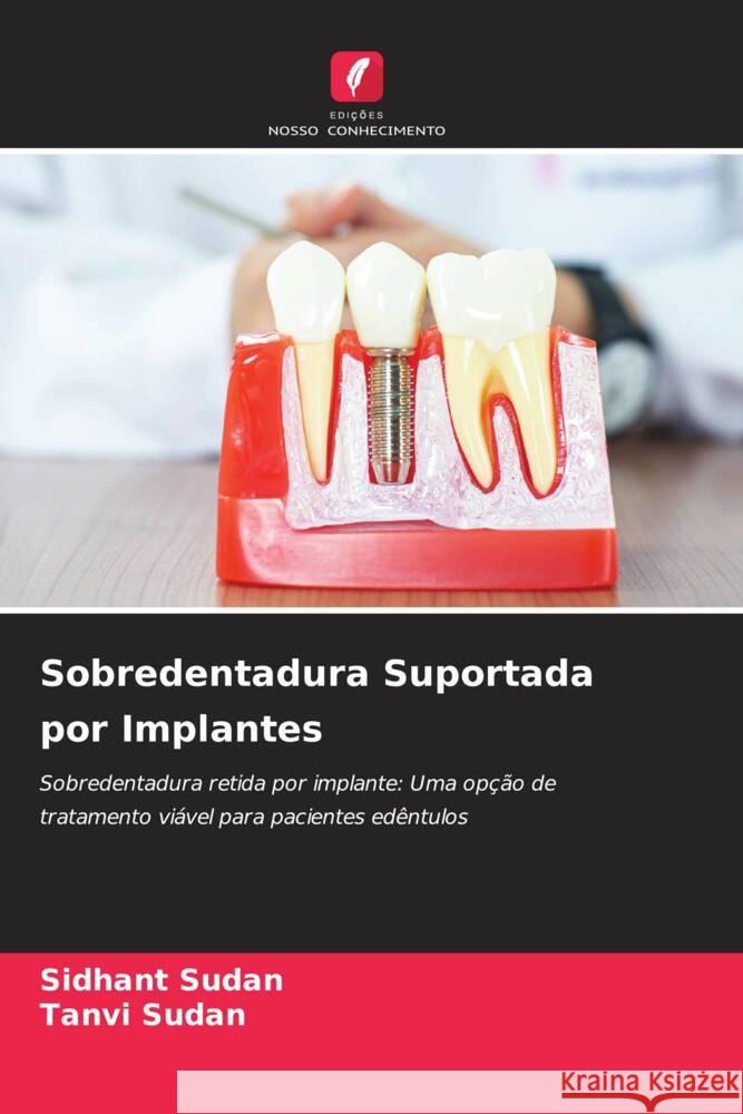 Sobredentadura Suportada por Implantes Sudan, Sidhant, Sudan, Tanvi 9786205084632 Edições Nosso Conhecimento - książka