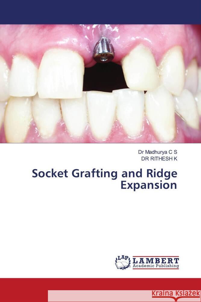 Socket Grafting and Ridge Expansion C S, Dr Madhurya, K, DR RITHESH 9786206766964 LAP Lambert Academic Publishing - książka