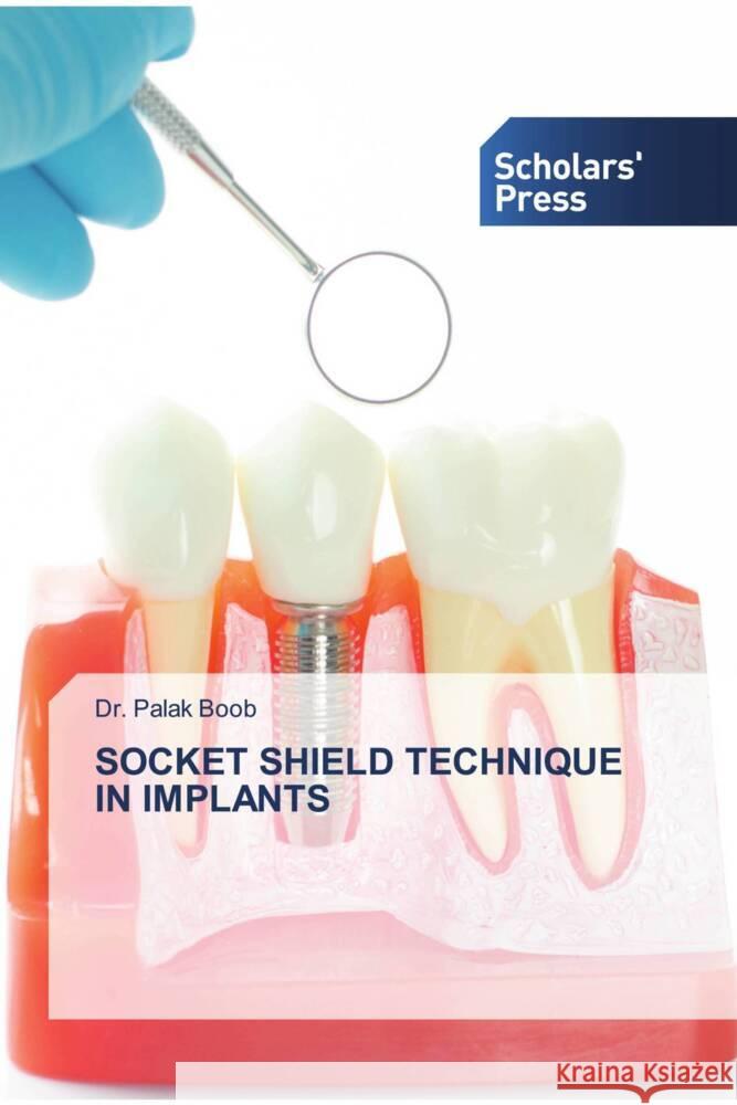 Socket Shield Technique in Implants Palak Boob 9786206771340 Scholars' Press - książka