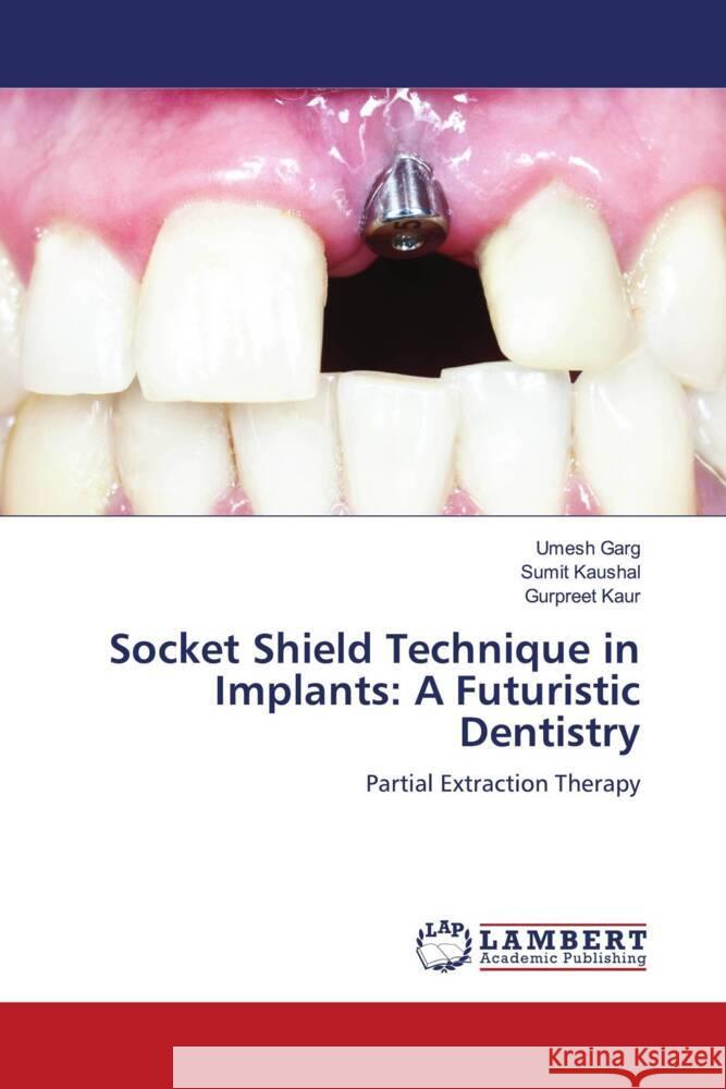 Socket Shield Technique in Implants: A Futuristic Dentistry Garg, Umesh, Kaushal, Sumit, Kaur, Gurpreet 9786205491720 LAP Lambert Academic Publishing - książka