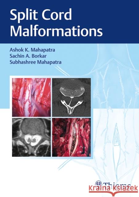 Split Cord Malformations Mahapatra, Ashok, Borkar, Sachin, Mahapatra, Subhashree 9788194857099 Thieme, Stuttgart - książka