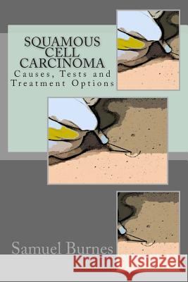 Squamous Cell Carcinoma: Causes, Tests and Treatment Options Samuel Burne Graham Chamberlai 9781469943763 Createspace - książka