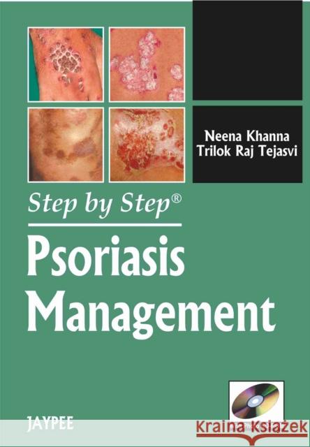 Step by Step: Psoriasis Management Neena Khanna 9789350251263 Jp Medical Ltd - książka
