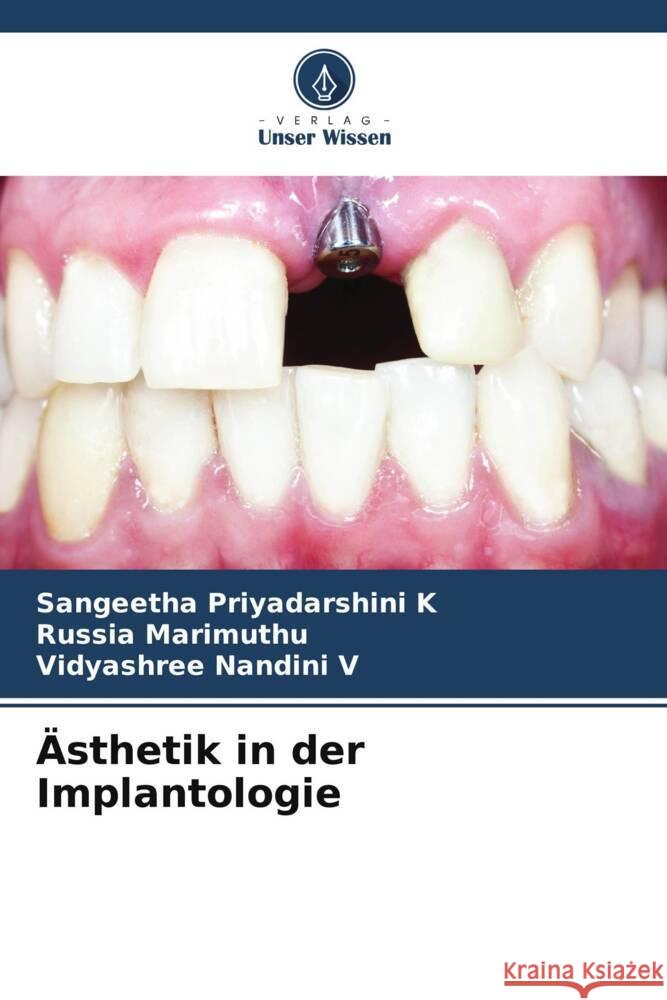 Ästhetik in der Implantologie K, Sangeetha Priyadarshini, Marimuthu, Russia, V, Vidyashree Nandini 9786206393368 Verlag Unser Wissen - książka
