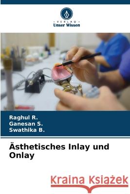 Ästhetisches Inlay und Onlay R., Raghul, S., Ganesan, B., Swathika 9786202419819 Verlag Unser Wissen - książka