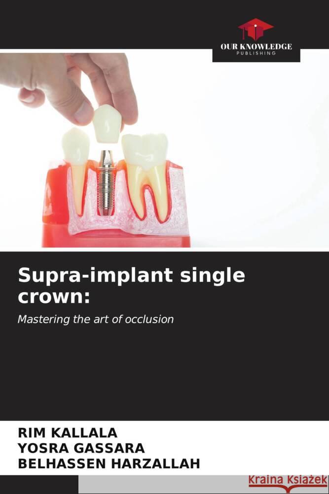 Supra-implant single crown: Kallala, Rim, Gassara, Yosra, Harzallah, Belhassen 9786206675730 Our Knowledge Publishing - książka