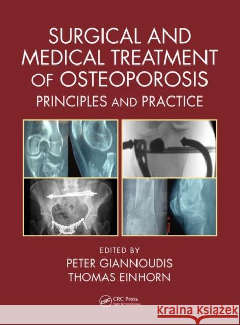 Surgical and Medical Treatment of Osteoporosis: Principles and Practice Peter V. Giannoudis Thomas A. Einhor 9781498732246 CRC Press - książka