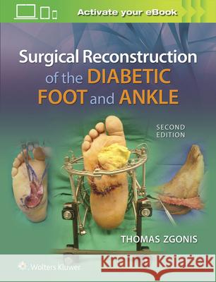 Surgical Reconstruction of the Diabetic Foot and Ankle Thomas Zgonis 9781496330079 LWW - książka