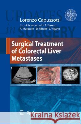 Surgical Treatment of Colorectal Liver Metastases Lorenzo Capussotti 9788847018082 Not Avail - książka